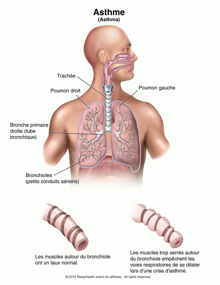 Asthme: Illustration