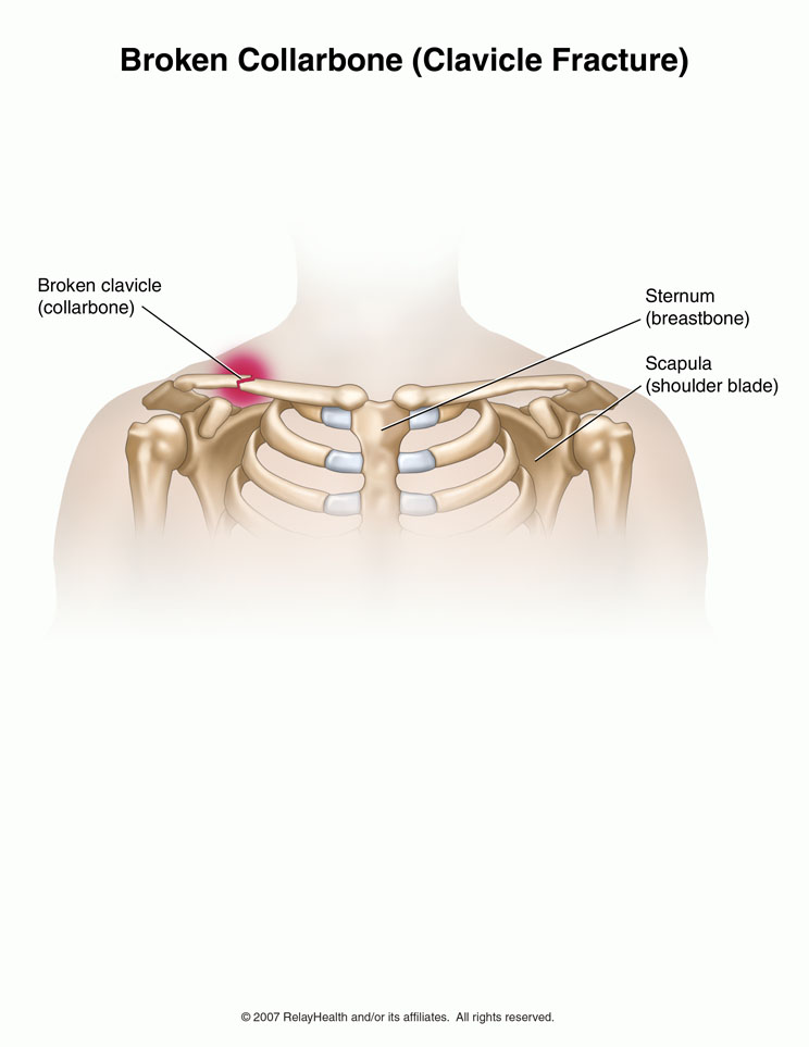 Collarbone Fracture: Illustration
