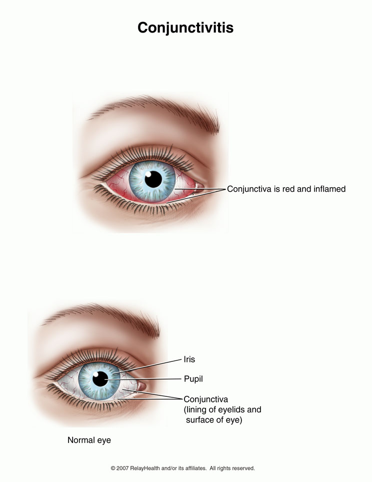 Eye Inflammation: Illustration