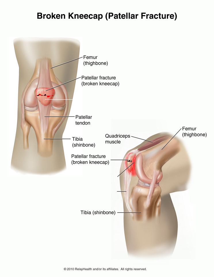 Kneecap Fracture: Illustration