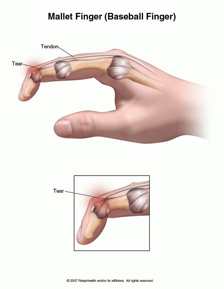 Mallet Finger (Baseball Finger): Illustration