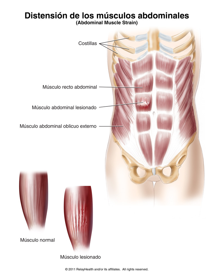 Distensión de los músculos abdominales: ilustración