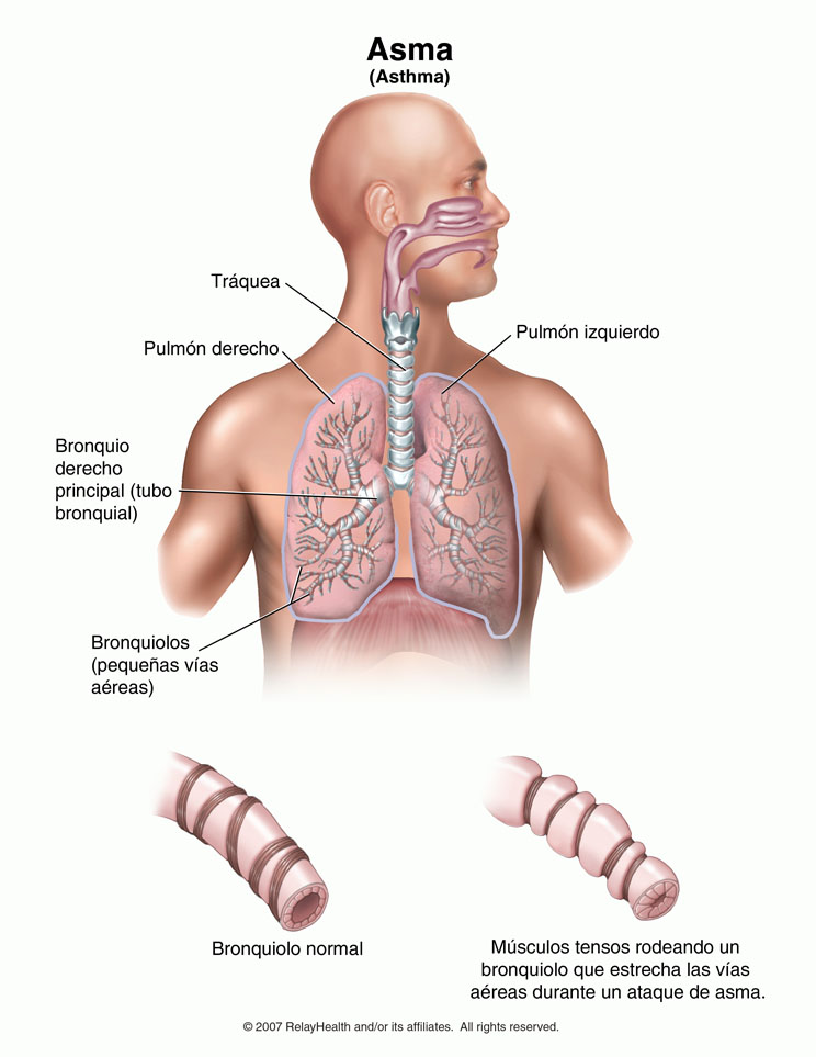 Estrechamiento de los bronquiolos en el asma: ilustración