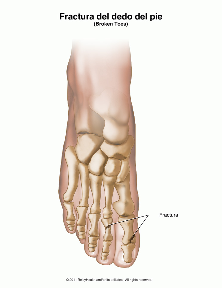 Fractura del dedo del pie: ilustración