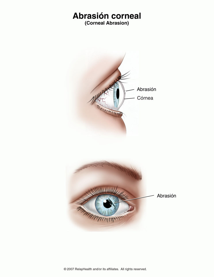 Abrasión corneal: ilustración