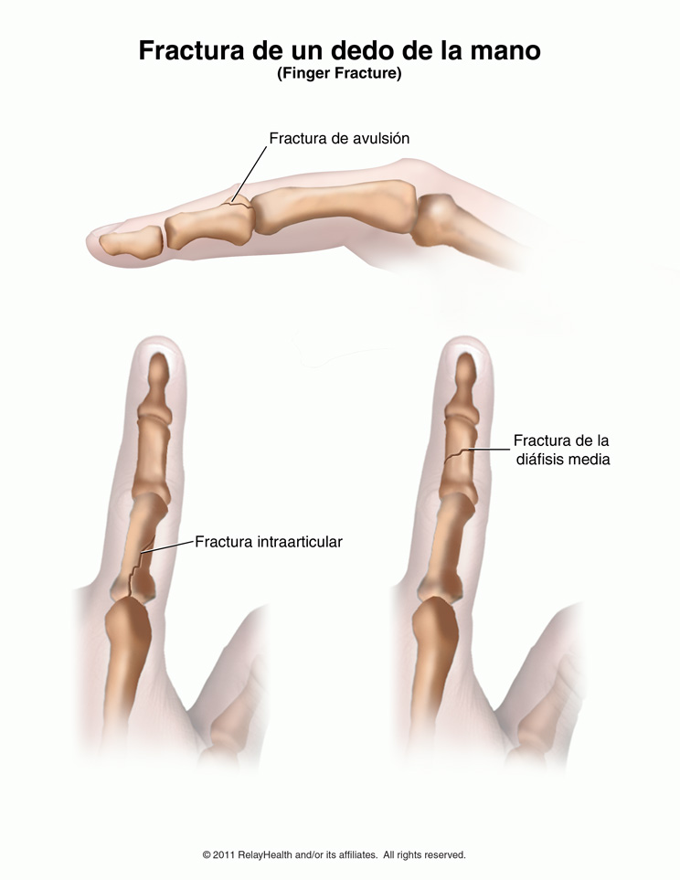 Fractura de un dedo de la mano: ilustración
