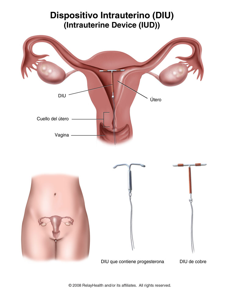 Dispositivo intrauterino - DIU: ilustración