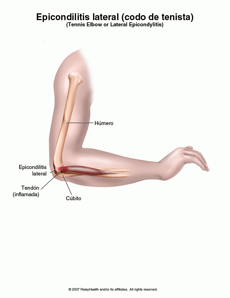 Epicondilitis lateral: ilustración