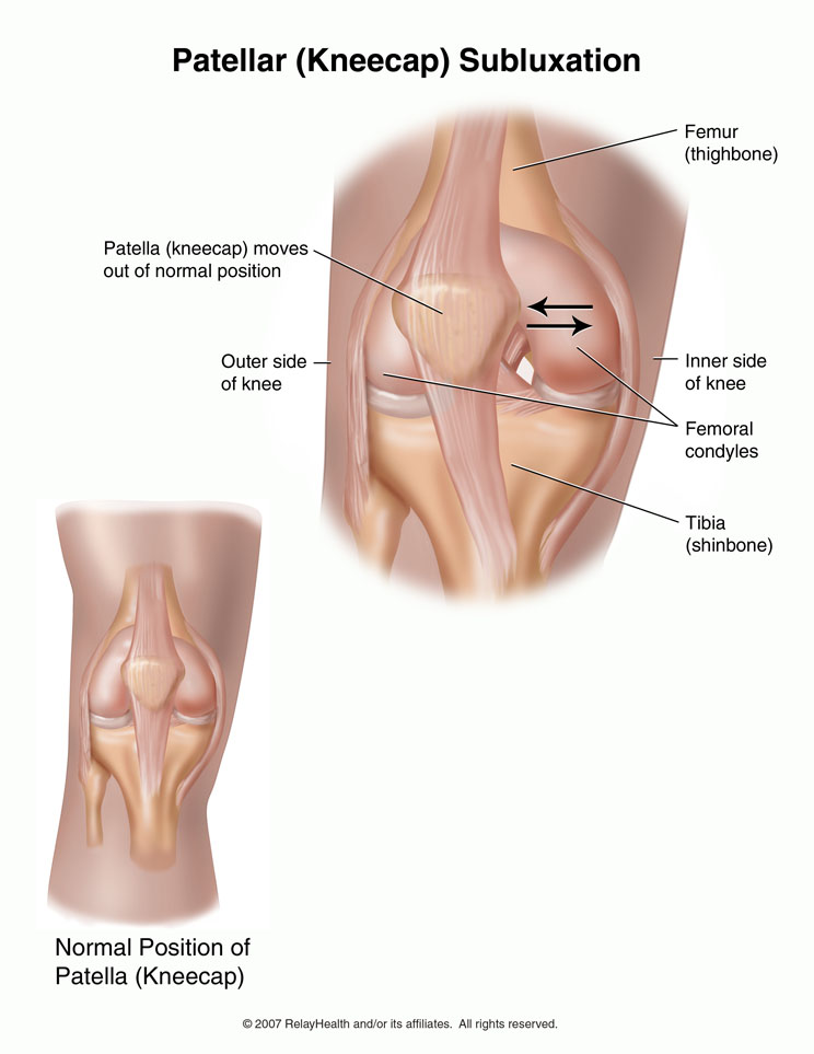 Kneecap Subluxation: Illustration