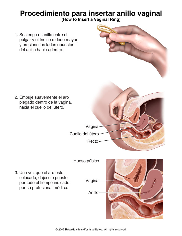 Anillo anticonceptivo vaginal: ilustración