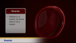 Thumbnail image of: Anemia (Animation)