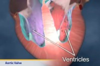 Thumbnail image of: Aortic Valve (Animation)
