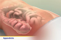 Thumbnail image of: Appendicitis (pediatric) (Animation)