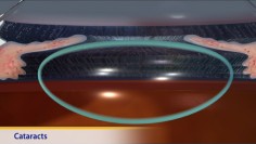 Thumbnail image of: Cataracts (Animation)