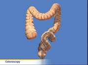 Thumbnail image of: Colonoscopy (pediatric) (Animation)