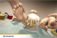 Thumbnail image of: Developmental Dysplasia of the Hip (pediatric) (Animation)