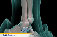 Thumbnail image of: Ankle Fracture (pediatric) (Animation)