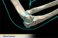 Thumbnail image of: Elbow Fracture (Olecranon Fracture) (pediatric) (Animation)