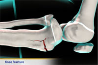 Thumbnail image of: Knee Fracture (pediatric) (Animation)