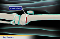 Thumbnail image of: Leg Fracture (pediatric) (Animation)