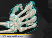Thumbnail image of: Fifth Metacarpal Fracture (Boxer's Fracture) (pediatric) (Animation)