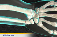 Thumbnail image of: Wrist Fracture (pediatric) (Animation)