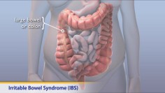 Thumbnail image of: Irritable Bowel Syndrome (IBS) (Animation)