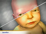 Thumbnail image of: Jaundice (pediatric) (Animation)