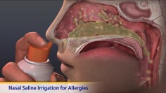 Thumbnail image of: Nasal Saline Irrigation for Allergies (Animation)
