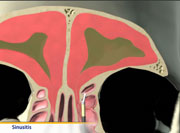 Thumbnail image of: Sinusitis (Animation)