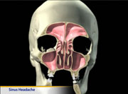 Thumbnail image of: Sinus Headaches (Animation)