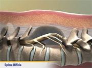 Thumbnail image of: Spina bifida (pediatric) (Animation)