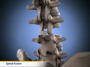 Thumbnail image of: Spinal Fusion (Animation)