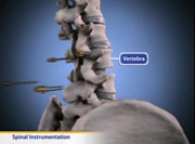 Thumbnail image of: Spinal Instrumentation (Animation)