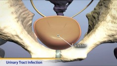 Thumbnail image of: Urinary Tract Infection (Animation)