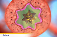 Thumbnail image of: Asthma (pediatric) (Animation)