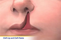 Thumbnail image of: Cleft Lip and Cleft Palate Surgery (pediatric) (Animation)