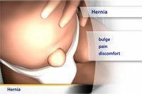 Thumbnail image of: Hernias (pediatric) (Animation)