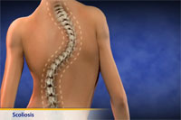 Thumbnail image of: Scoliosis (pediatric) (Animation)