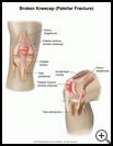 Thumbnail image of: Kneecap Fracture: Illustration