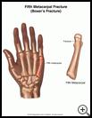 Thumbnail image of: Hand Fracture: Fifth Metacarpal (Boxer's) Fracture, Illustration