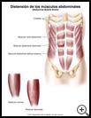 Thumbnail image of: Distensión de los músculos abdominales: ilustración