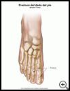 Thumbnail image of: Fractura del dedo del pie: ilustración