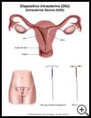 Thumbnail image of: Dispositivo intrauterino - DIU: ilustración