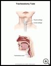 Thumbnail image of: Tracheostomy Tube: Illustration