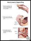 Thumbnail image of: Vaginal Contraceptive Ring, How to Insert: Illustration