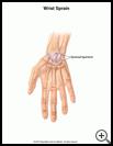 Thumbnail image of: Wrist Sprain: Illustration