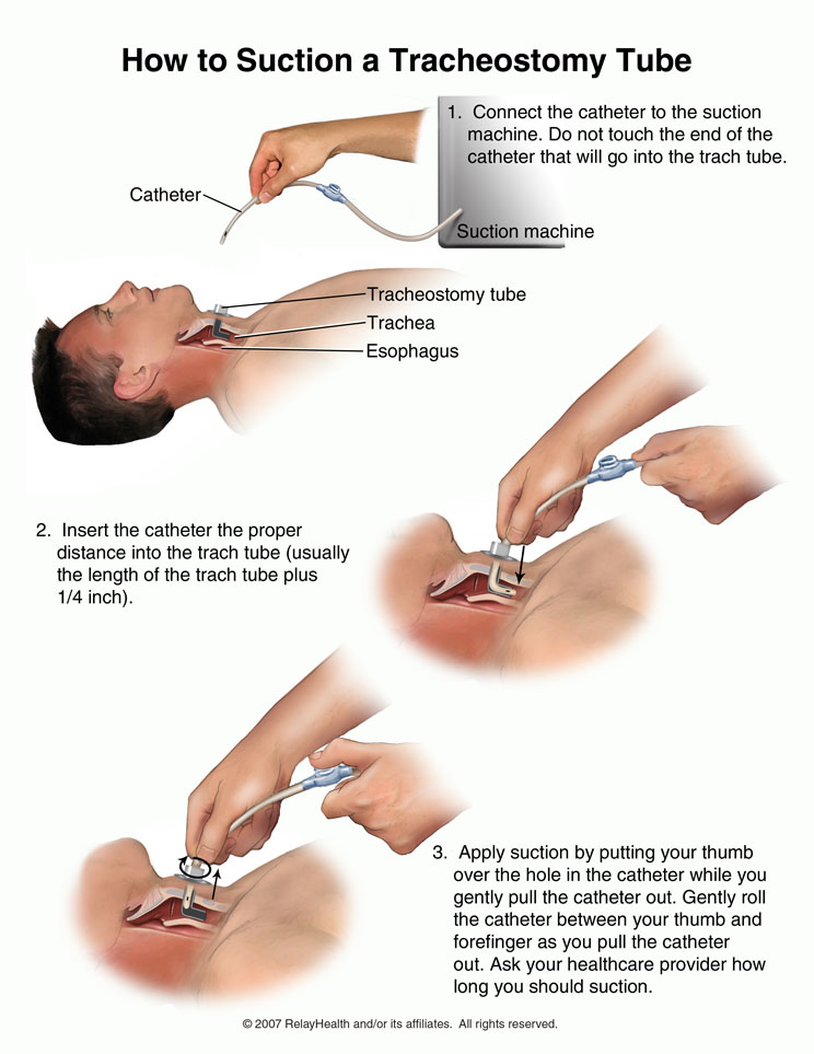 Tracheostomy Tube, How to Suction: Illustration