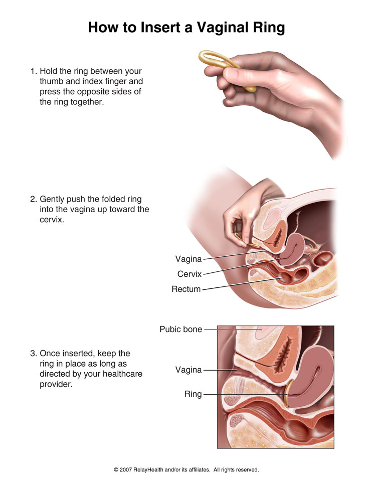 Vaginal Contraceptive Ring, How to Insert: Illustration