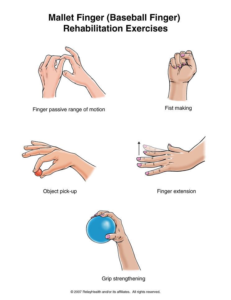 Mallet Finger (Baseball Finger) Exercises: Illustration